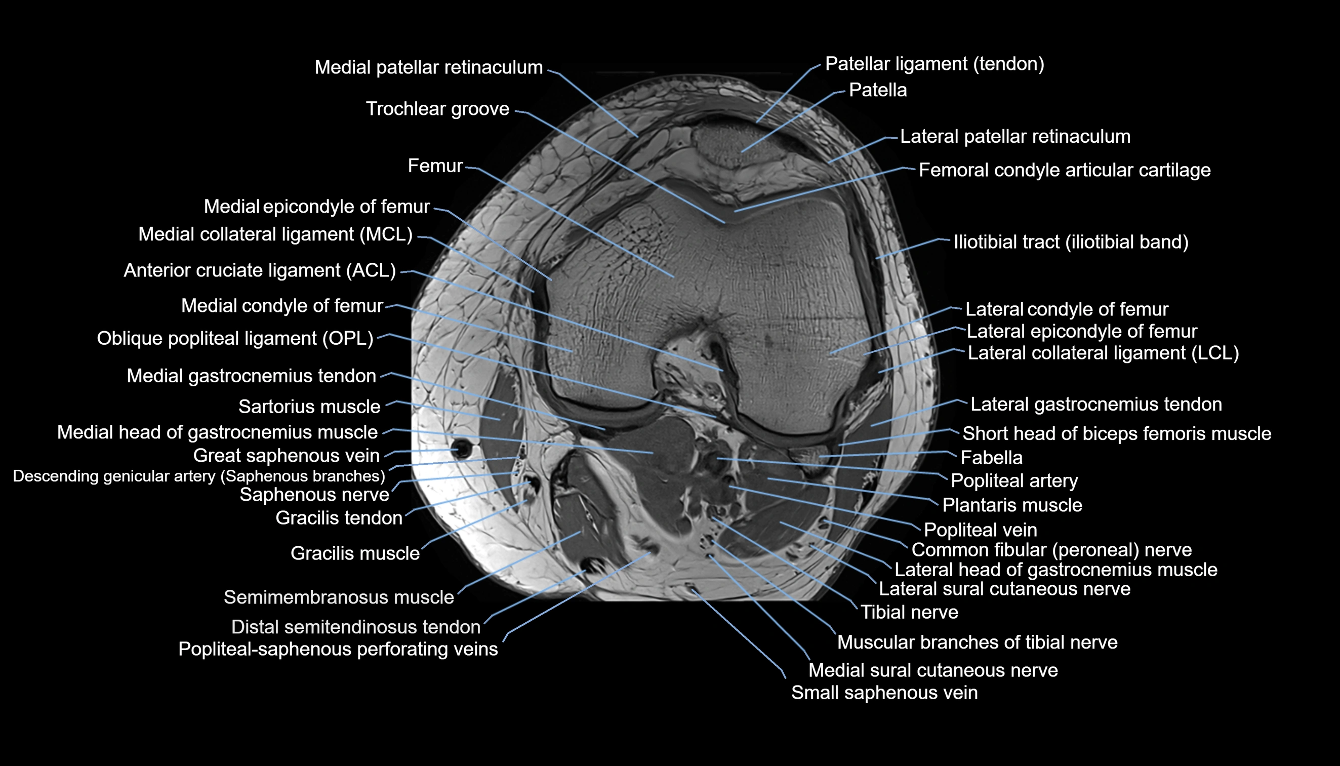 MRI knee  axial cross sectional anatomy 3T radiology  image-img-00001-00021.webp